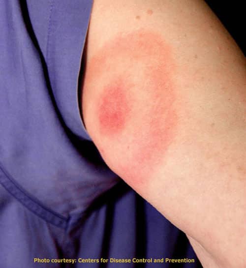 Lyme's disease rash