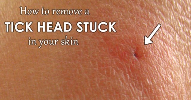 How To Remove A Stuck Tick Head In Your Skin Safe Method