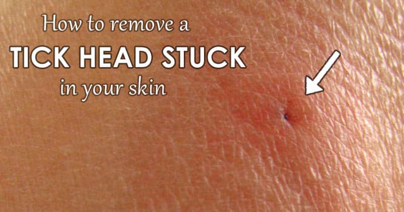 remove tick head stuck in skin
