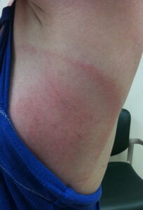 Lyme Disease Rash Photos: Early Stage and Bulls Eye 2026